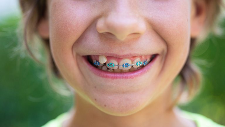How to Prepare Your Child for Their First Braces Appointment
