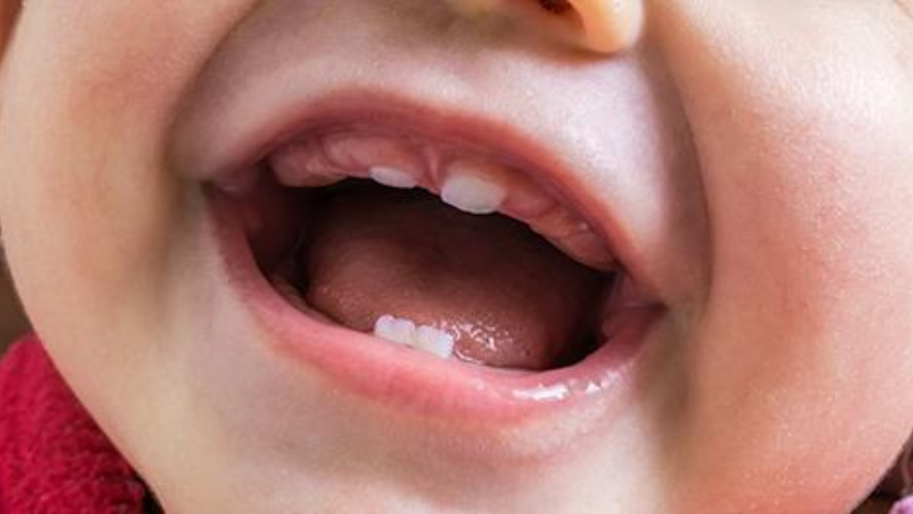 Lip Ties: Causes, Symptoms, and Treatment