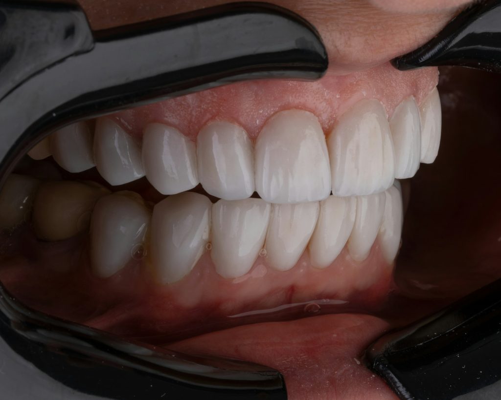 What Are the Pros and Cons of Dental Veneers?